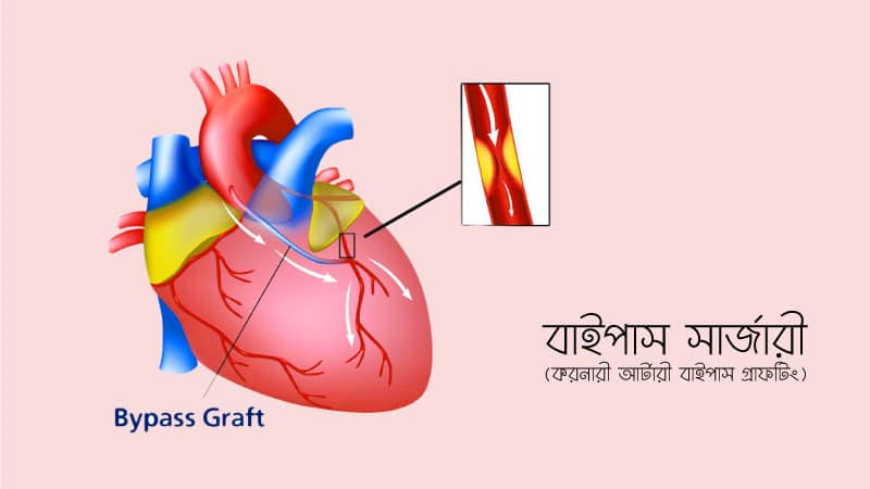 বাইপাস সার্জারী (করোনারী আর্টারী বাইপাস গ্রাফটিং) এবং পরবর্তী ব্যবস্থাপনা
